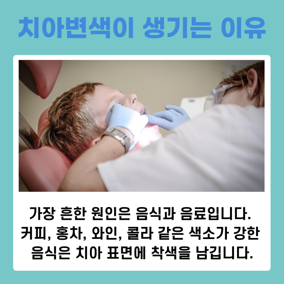 치아변색원인과 스케일링치료로 개선하는 방법 관련 이미지 3