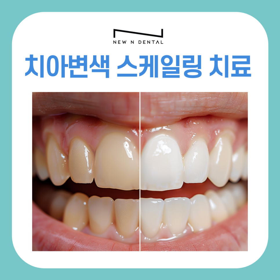 치아변색원인과 스케일링치료로 개선하는 방법 관련 이미지 2