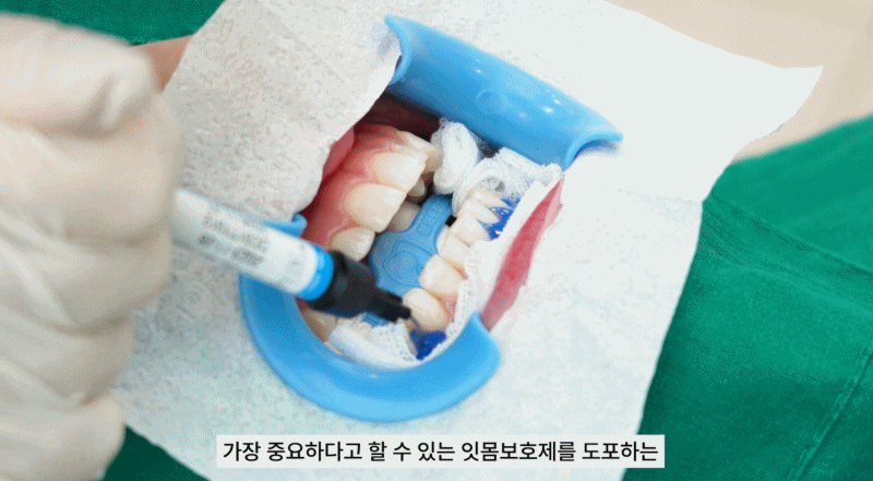 강남치과 원데이치아미백 누런치아 탈출 관련 이미지 8