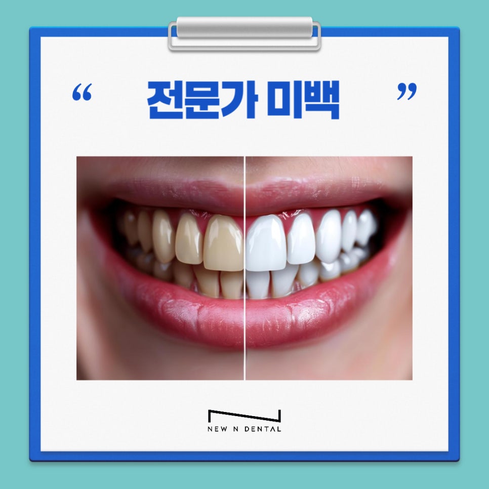강남치과 원데이치아미백 누런치아 탈출 관련 이미지 2