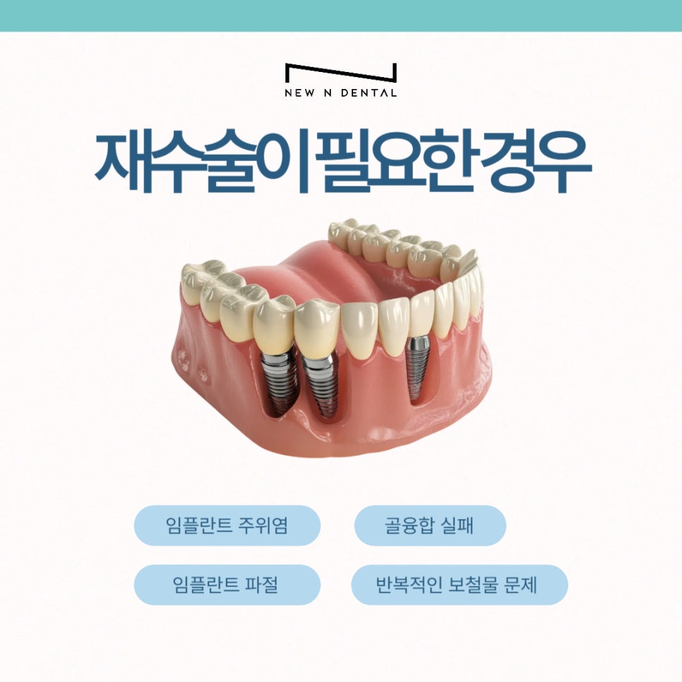 강남 임플란트 재수술, 어떤 경우에 필요할까 관련 이미지 3