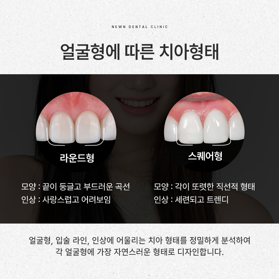 강남역 뉴엔치과 일반 라미네이트와 퍼스널라미의 차이점 관련 이미지 7