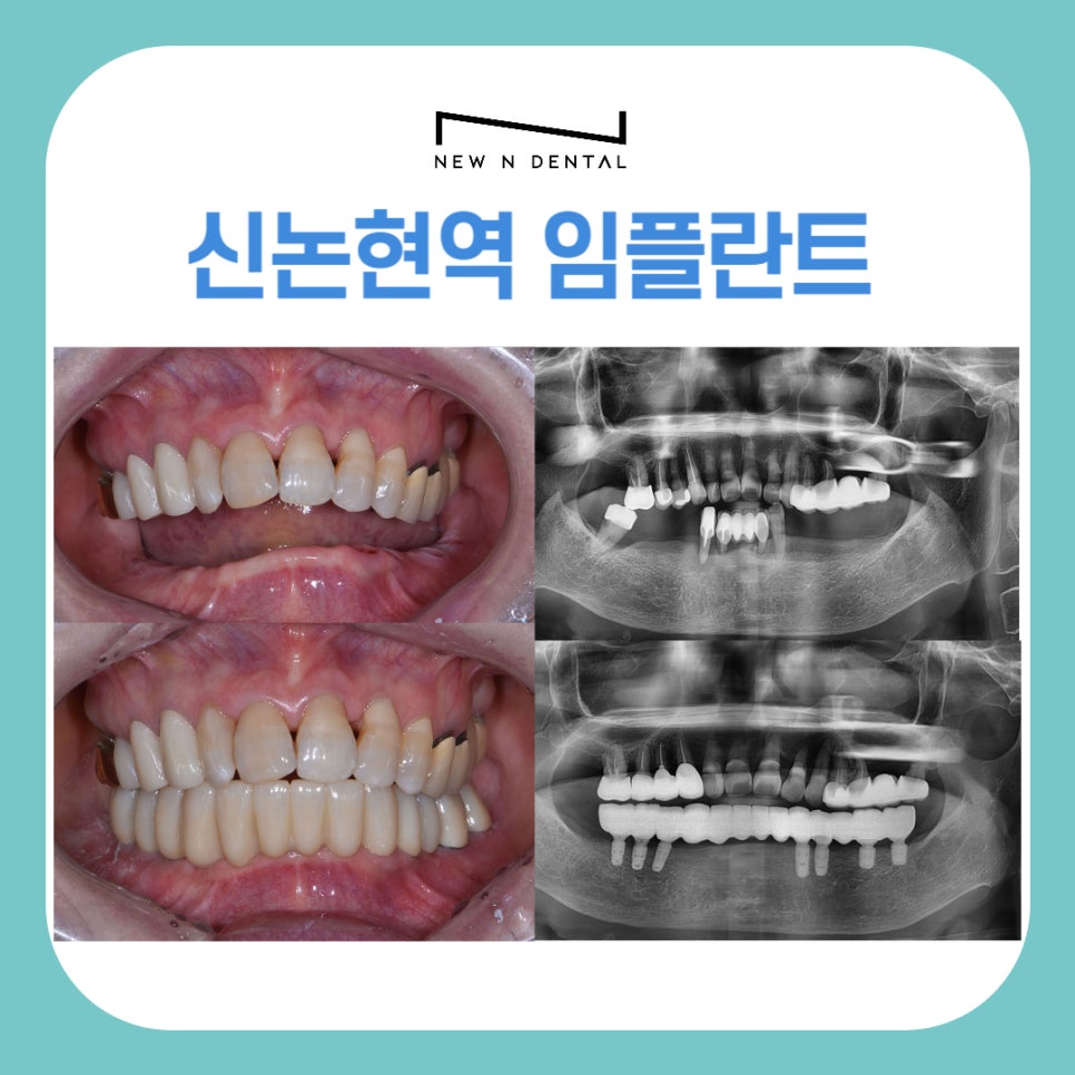 신논현역임플란트 건강하고 오래쓰는 임플란트 관련 이미지 2