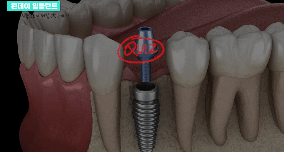 원데이 임플란트 빠르게 치료하려면 관련 이미지 8