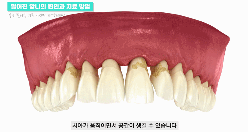 앞니 벌어짐 치료의 원인과 치료 방법 관련 이미지 8