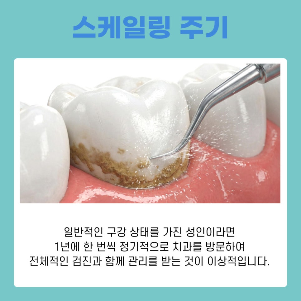 Gangnam Scaling Frequency and Essential Care for Preventing Gum Disease image 10