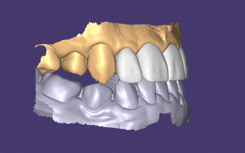 강남역 뉴엔치과 일반 라미네이트와 퍼스널라미의 차이점 관련 이미지 14