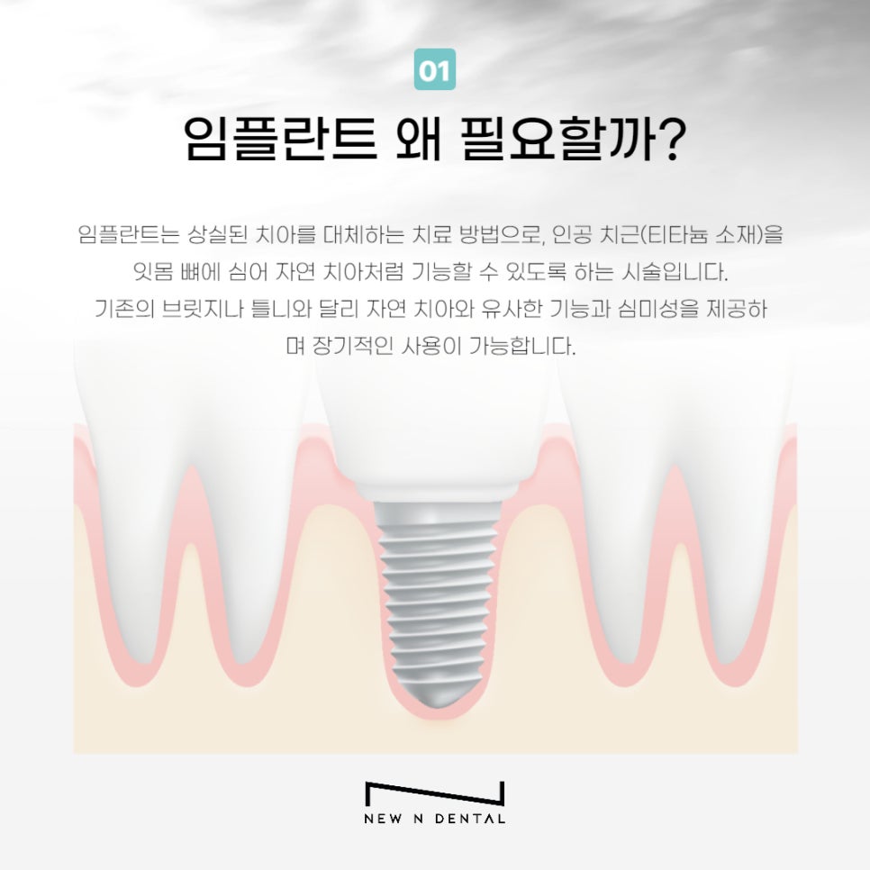 강남임플란트추천 식립 고민중이라면 관련 이미지 2