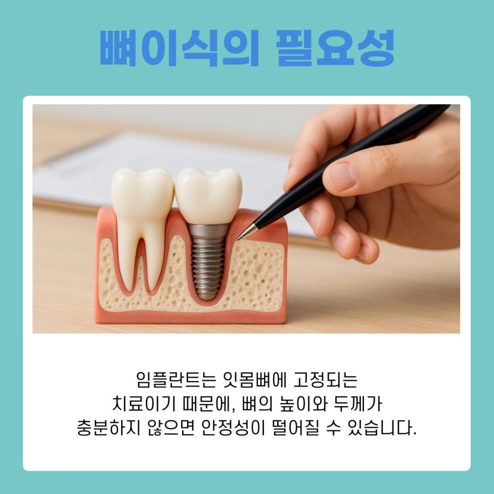 강남 역삼동 임플란트 뼈이식 과정과 회복 기간 이것만 알면 끝 관련 이미지 7