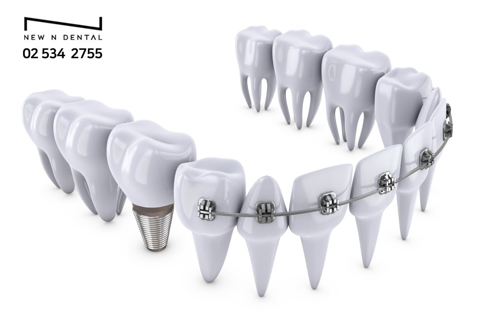 논현동치과 임플란트 식립 잘하는 곳 관련 이미지 4