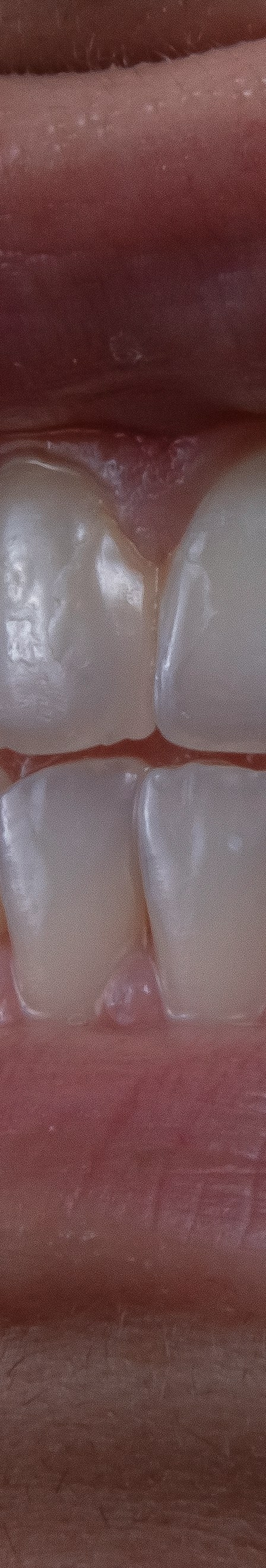 치아 미백 효과와 부작용 체크해야 할 사항 관련 이미지 22