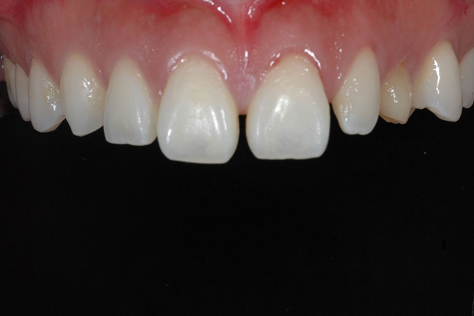 서초동라미네이트 치아를 아름답게 관련 이미지 5