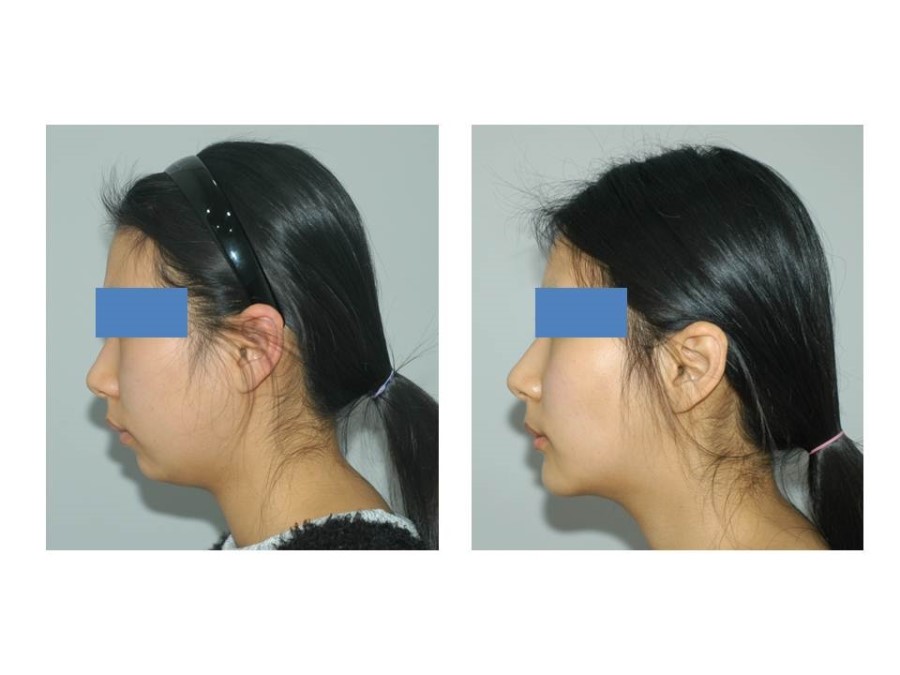 Deep Buccal Fat Removal, Double Chin Liposuction, and Progress After Genioplasty image 5