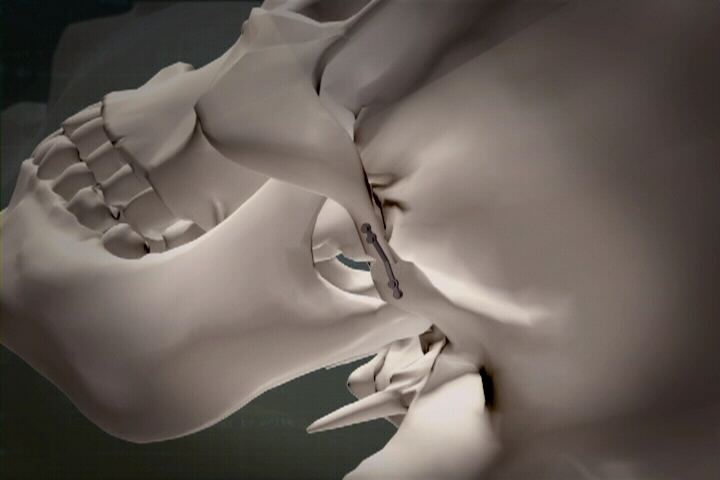The Evolution of Infracture Technique for Reduction Malarplasty 관련 이미지 4