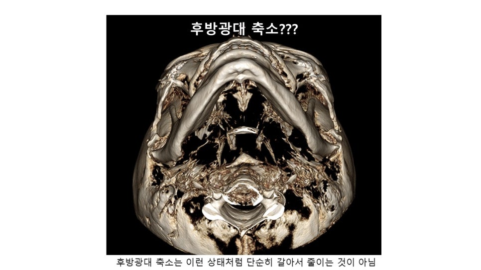 후방광대, 뒷광대 축소에 관한 그릇된 정보와 정확한 이해 관련 이미지 4