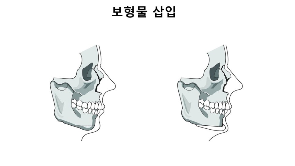 입체적인 옆라인의 완성, 무턱과 이중턱을 동시에 해결하는 방법 관련 이미지 10