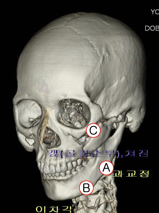 Pitfalls of Cheekbone Reduction Surgery Depending on the Method image 5
