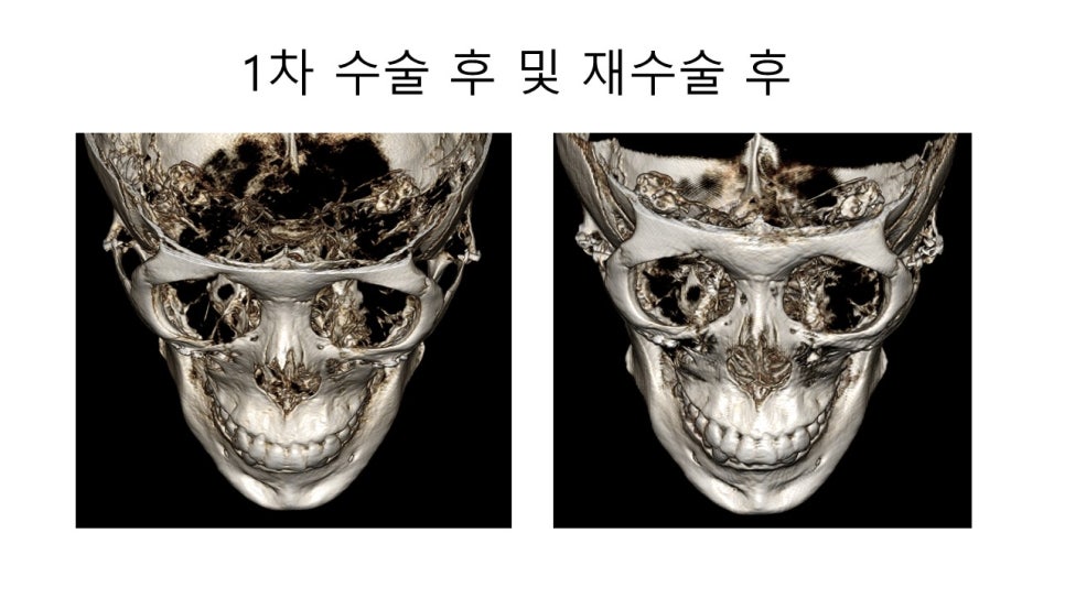 광대뼈 축소성형술 - 수술방법에 따른 모습변화의 차이 관련 이미지 6