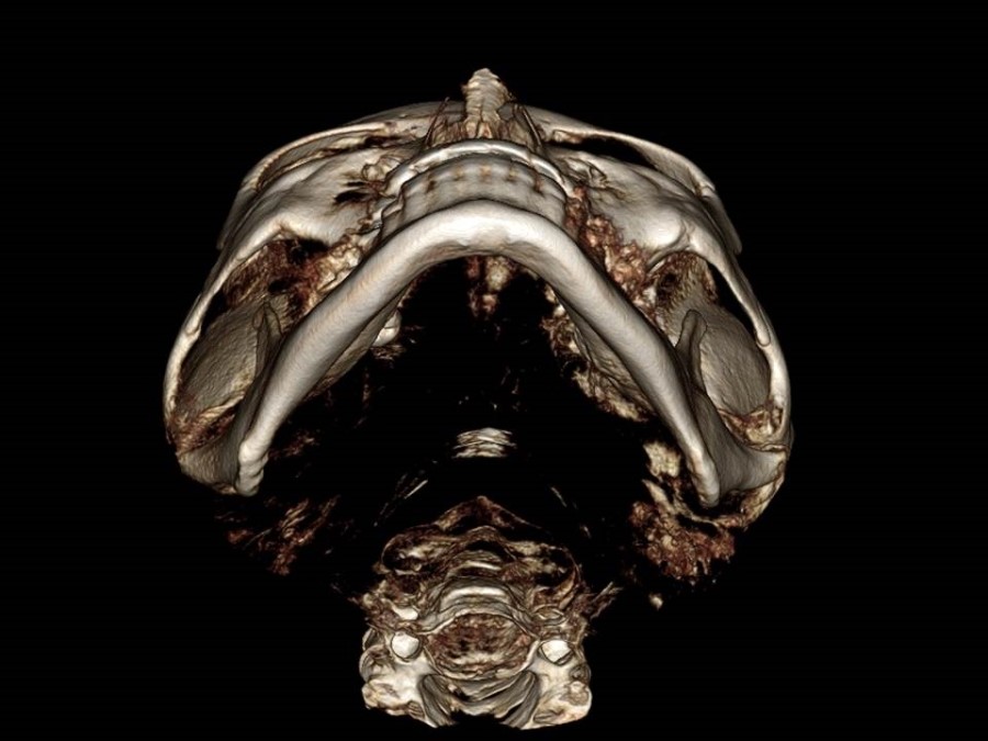 Understanding the Structure of the Cheekbone and Cheekbone Reduction Surgery image 3