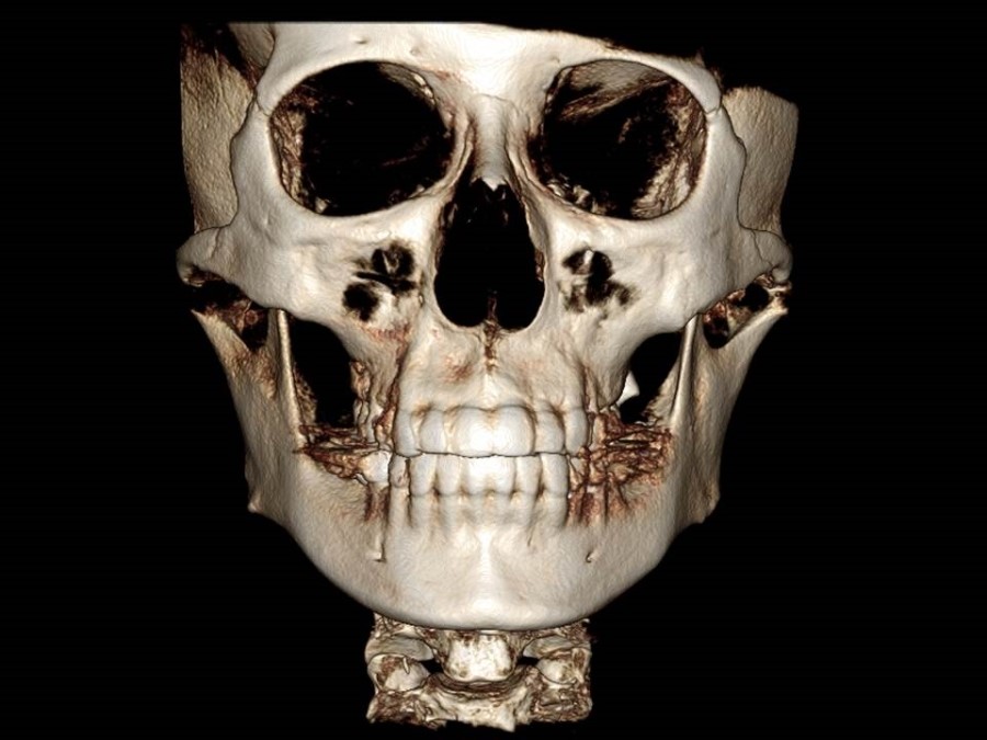 Understanding the Structure of the Cheekbone and Cheekbone Reduction Surgery image 7