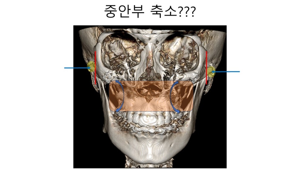 A Zygomatic Surgery Outcome That Makes Anger Surge image 17