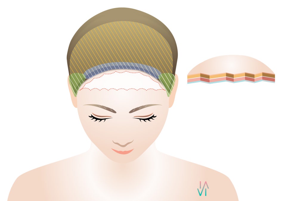A Proposal to Improve a Broad Forehead - Binary Surgery image 3