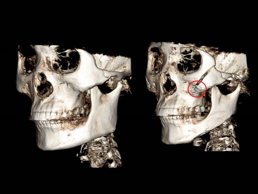Zygoma Reduction Surgery Through Complete Osteotomy of the Body and Arch image 6