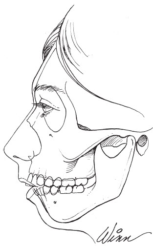 Overall Information About Chin Surgery for a Receded Chin image 1