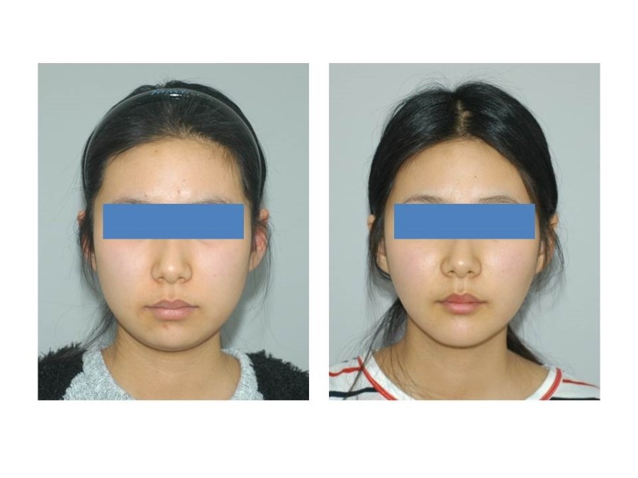 Deep Buccal Fat Removal, Double Chin Liposuction, and Progress After Genioplasty image 1