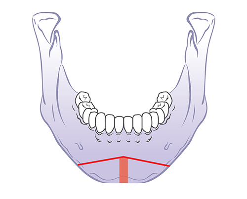 V-Line Square Jaw Surgery - The Appropriate Surgical Method According to the Shape of the Chin image 4