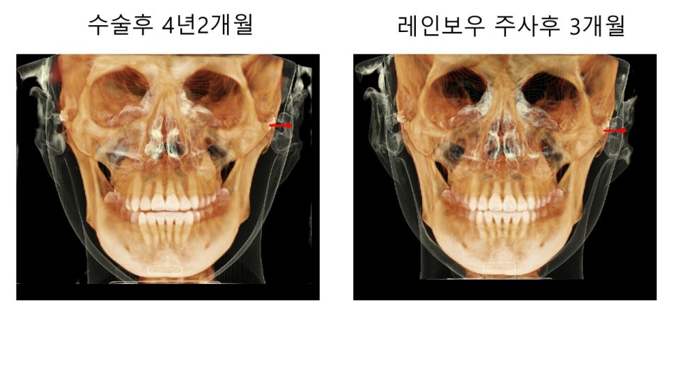 얼굴 윤곽에 있어서 연부조직의 중요성 - 윤곽주사, 레인보우 주사 관련 이미지 9