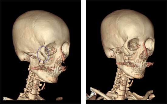 Revision Surgery for Cheekbone Surgery...Closing the Gap and Fixing the Side Cheekbone. image 1