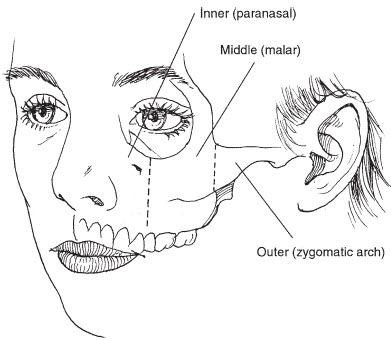 Understanding the Structure of the Cheekbone and Cheekbone Reduction Surgery image 1