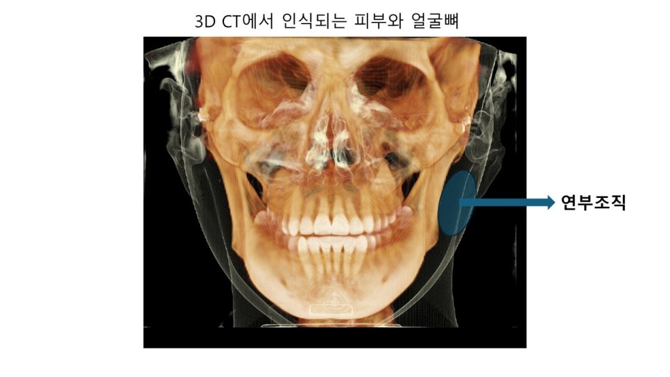 얼굴 윤곽에 있어서 연부조직의 중요성 - 윤곽주사, 레인보우 주사 관련 이미지 2