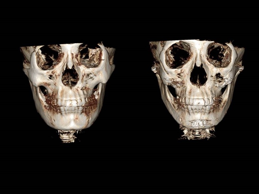 Zygoma Reduction Surgery Through Complete Osteotomy of the Body and Arch image 22