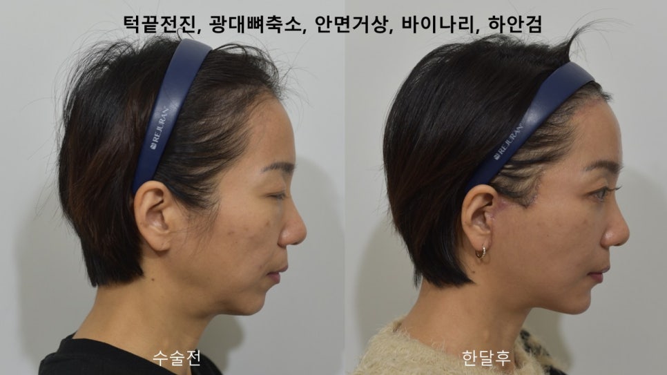 "윤곽거상 수술 " 실제 사례 소개 관련 이미지 13