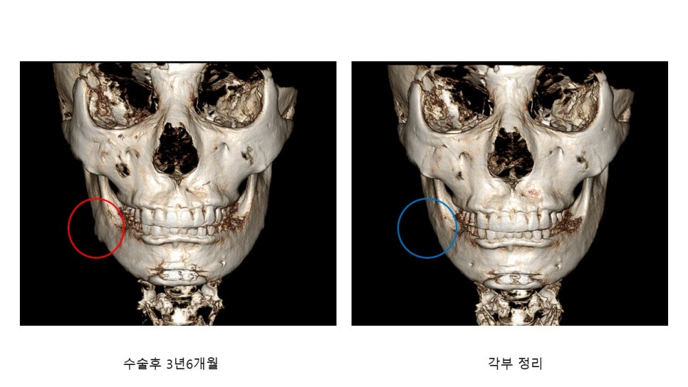 사각턱 수술후 시기에 따른 아랫턱뼈의 형태변화 관련 이미지 7