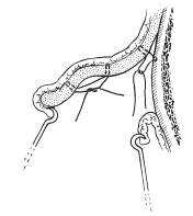 Protruding Ear Surgery image 2