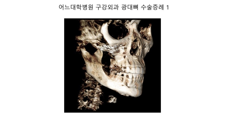 안면윤곽 수술전과 후의 증례 고찰 관련 이미지 14
