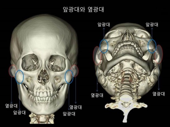 옆광대 축소를 위한 효과적인 방법 관련 이미지 2