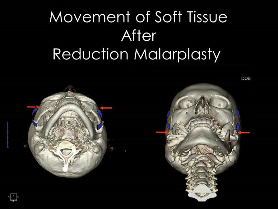 Facial Contouring Surgery and Cheek Sagging image 4
