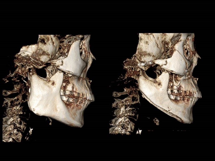 Zygoma Reduction Surgery Through Complete Osteotomy of the Body and Arch image 7