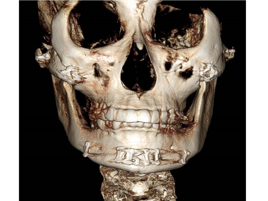 V-Line Square Jaw Surgery - The Truth and Reality of T-Osteotomy image 6