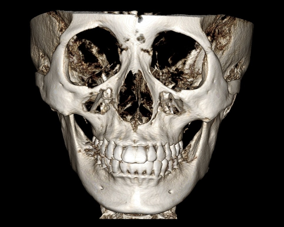 How Is Face Shape Determined? Factors That Determine Face Shape and Facial Contouring Surgery image 3