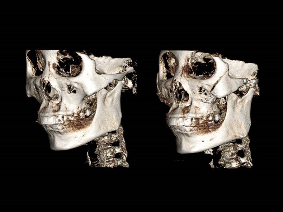 Zygoma Reduction Surgery Through Complete Osteotomy of the Body and Arch image 18