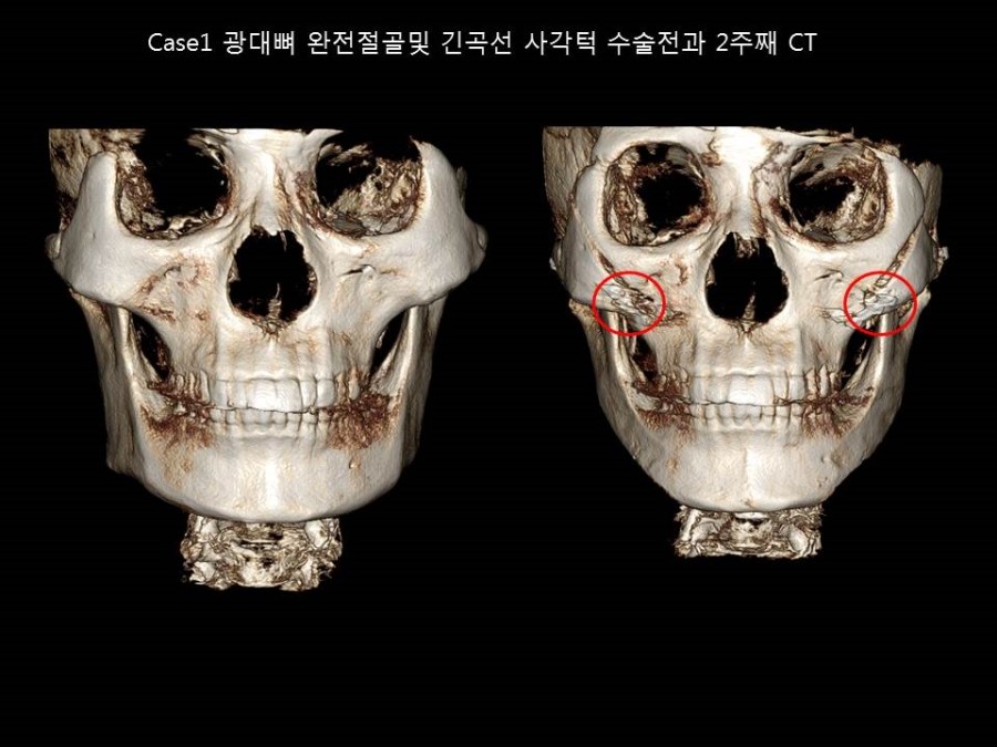 얼굴형에 따른 광대뼈 축소성형술 방법의 적절한 선택 관련 이미지 3