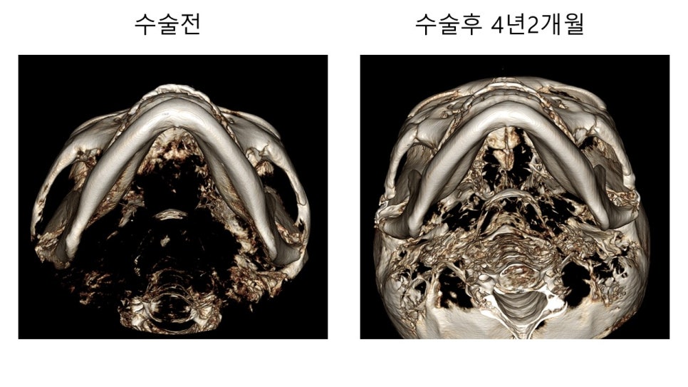 얼굴 윤곽에 있어서 연부조직의 중요성 - 윤곽주사, 레인보우 주사 관련 이미지 6
