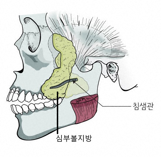 양악수술과 심부볼지방제거 관련 이미지 4