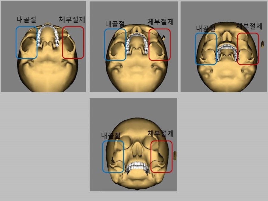 Meticulous Zygomatic Reduction Surgery image 2
