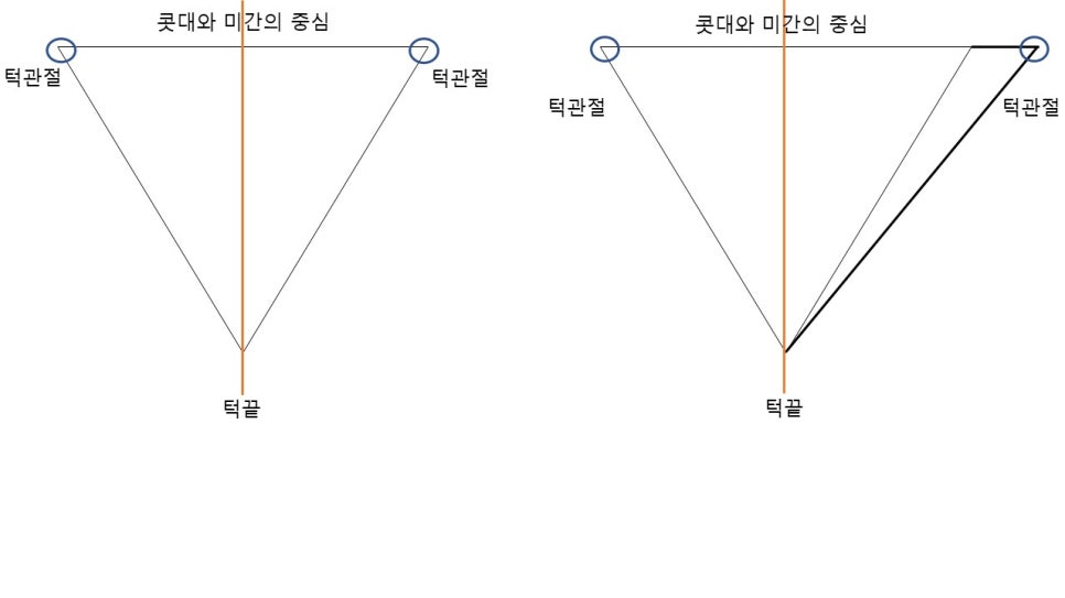 안면윤곽수술과 비대칭 교정의 효과 관련 이미지 3